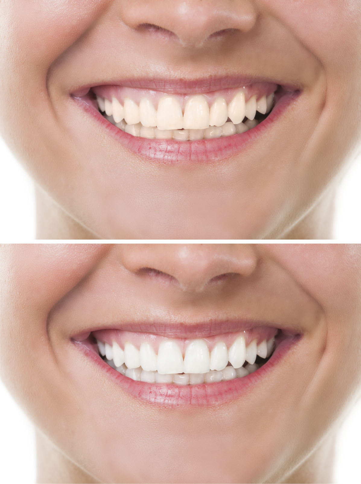 Professional Teeth Whitening in stamford