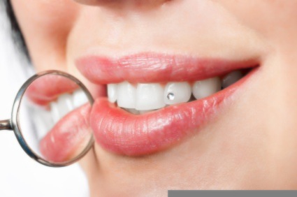 Tips to Protect Your Dental Implants