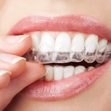 ClearCorrect in Stamford, CT: Tips for Its Proper Care