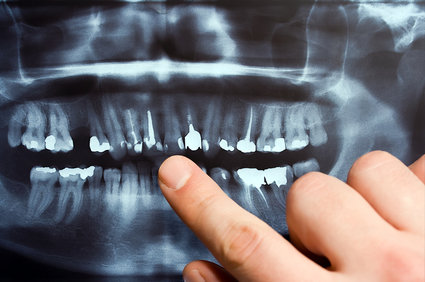 Dental X-Rays 