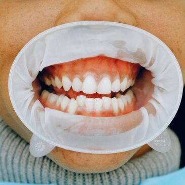 Treating gum disease in Stamford