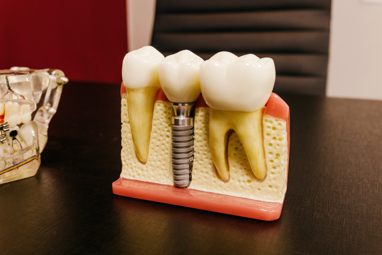 The Pros and Cons of Dental Implants: New smiles in Stamford