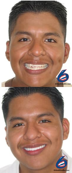 Want Straight Teeth in just 6 Months: Read! - Dental Care Stamford